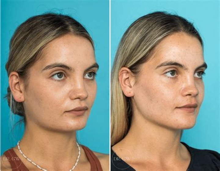 Celebrity Chin Implants: The Ultimate Guide To Enhance Your Appearance