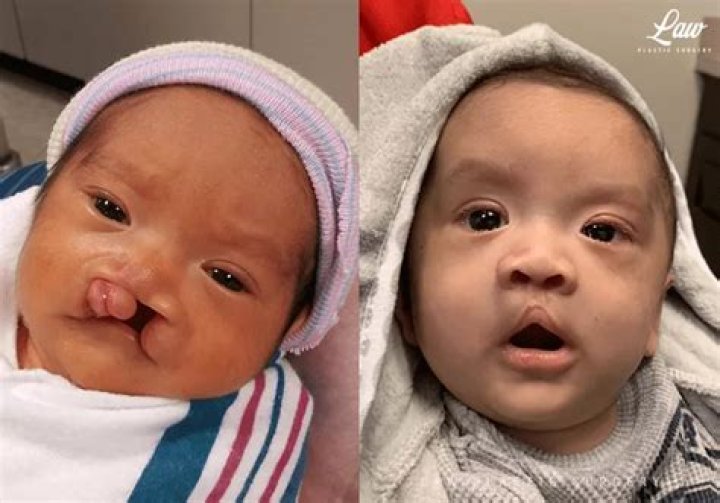 Celebrity Faces: Overcoming The Challenges Of Cleft Lip