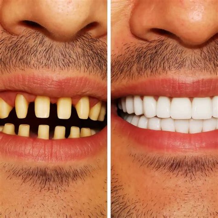 Does Usher Have Veneers? The Ultimate Guide To His Smile