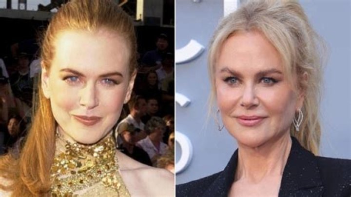 The Truth About Nicole Kidman's Plastic Surgery: Uncovering The Extent Of Her Procedures