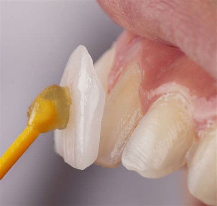 The Ultimate Guide To Plaster Teeth: From Creation To Care